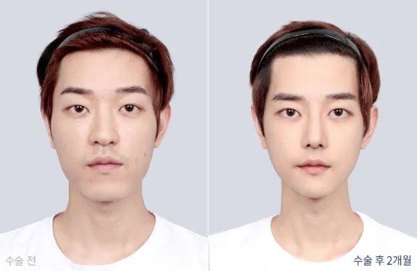 Before/After