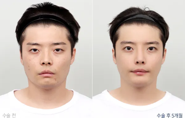 Before/After