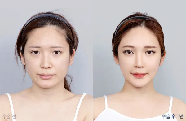 Before/After
