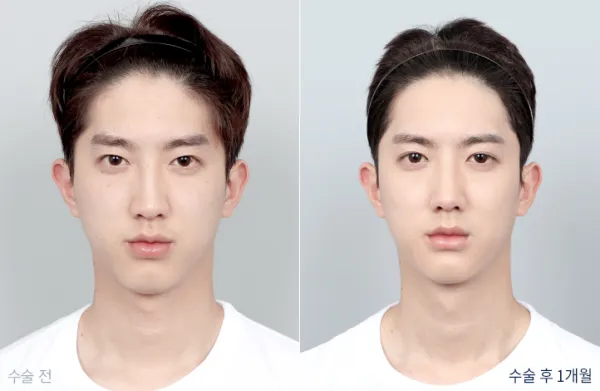 Before/After