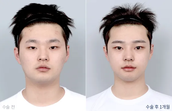 Before/After