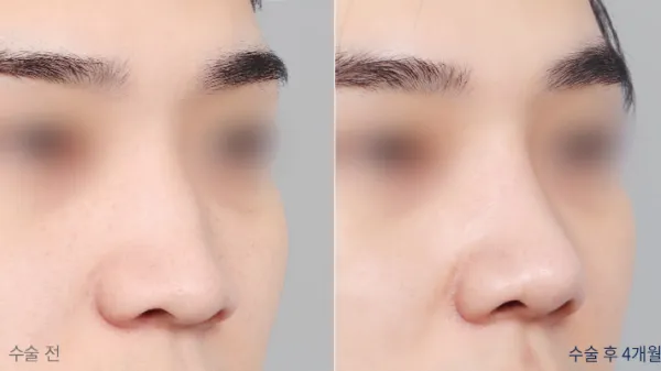 Before/After