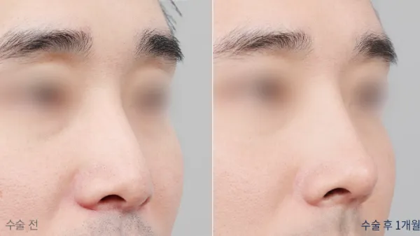 Before/After