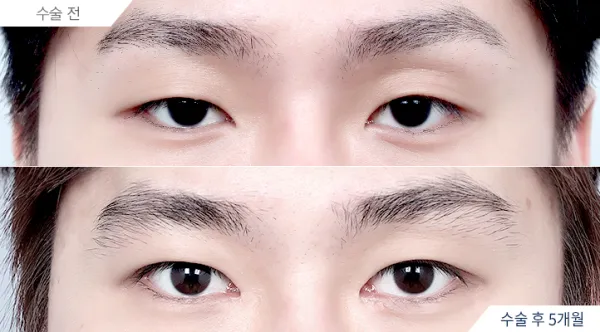Before/After