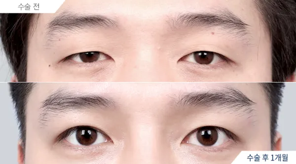 Before/After