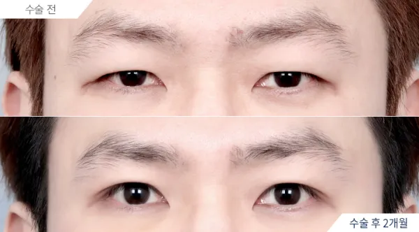 Before/After