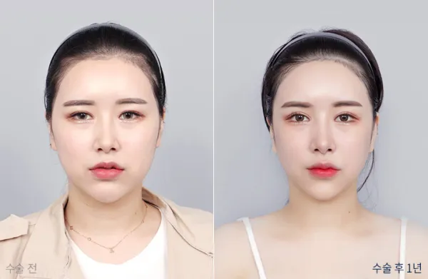 Before/After