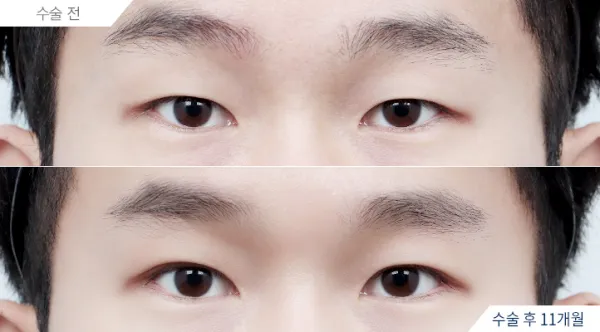 Before/After