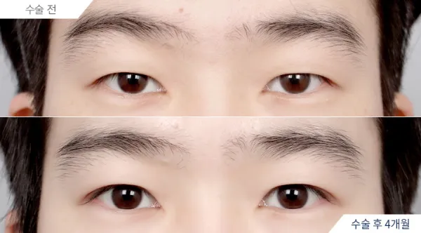 Before/After