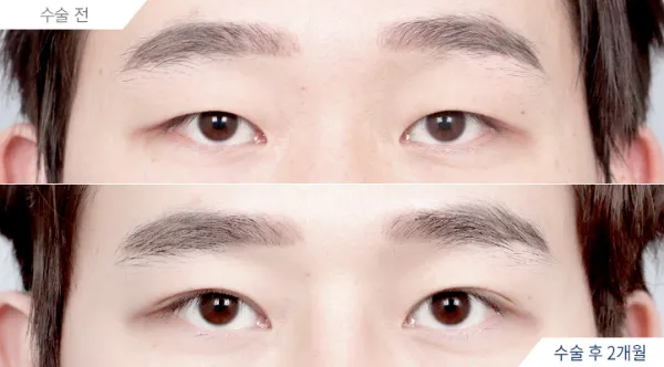 Before/After