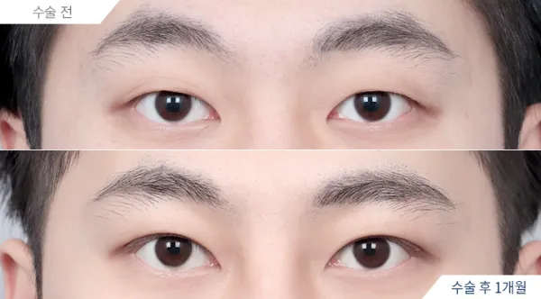 Before/After