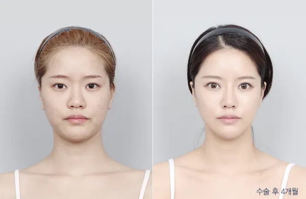 Before/After