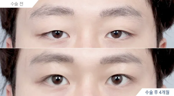 Before/After