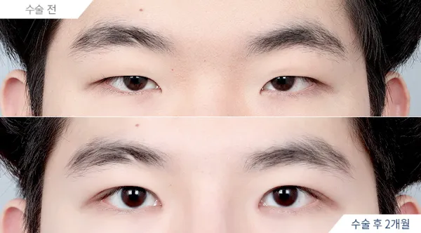Before/After