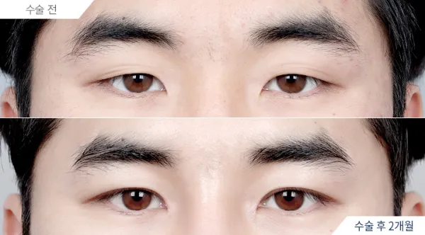 Before/After
