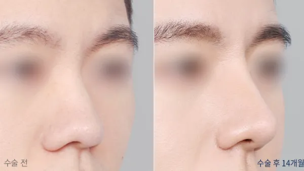Before/After