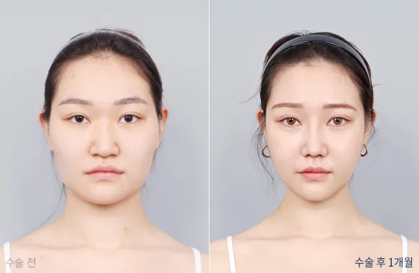Before/After