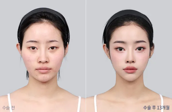 Before/After