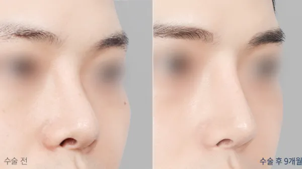 Before/After