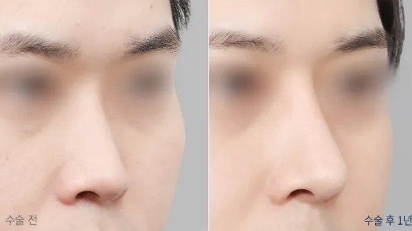 Before/After