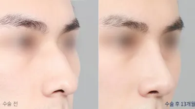 Before & After