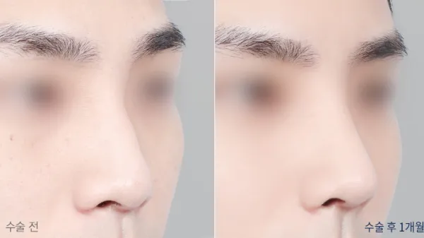 Before/After