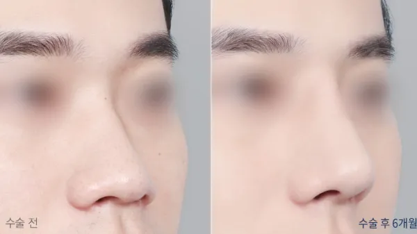 Before/After