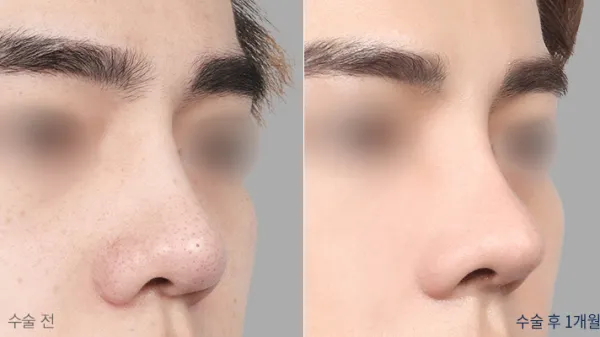 Before/After