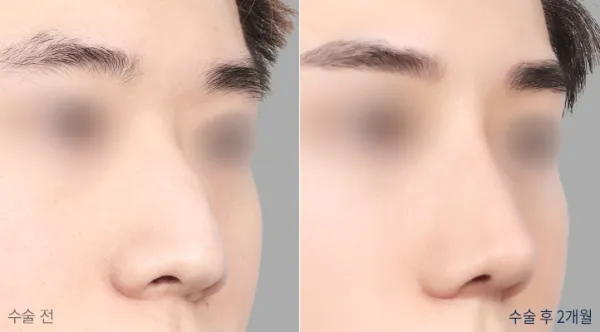 Before/After