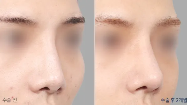 Before/After