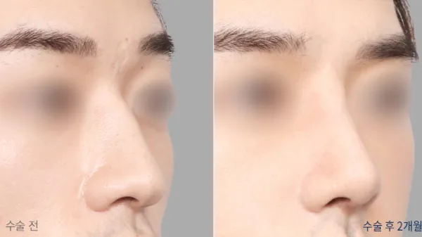 Before/After