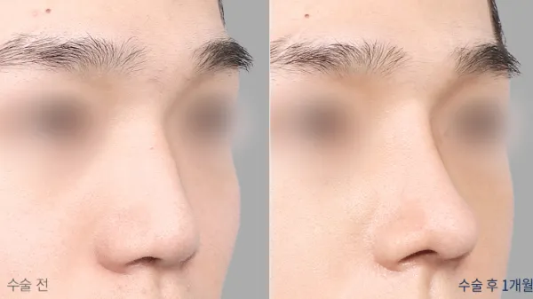 Before/After