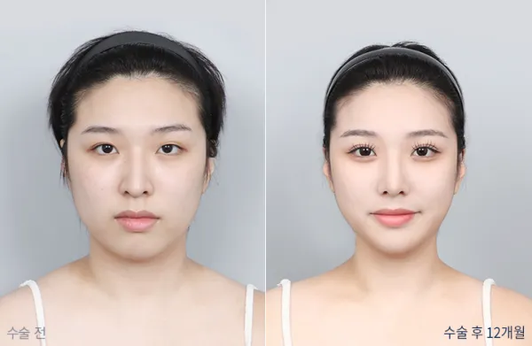 Before/After