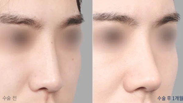 Before/After