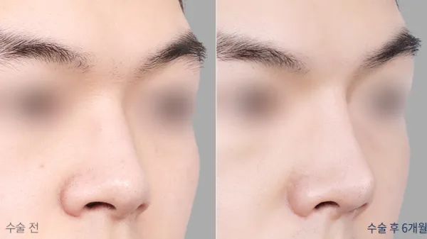 Before/After