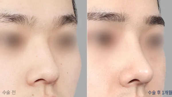 Before/After