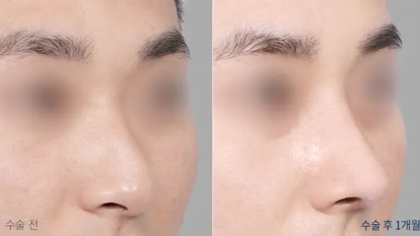 Before/After