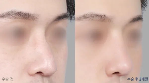 Before/After