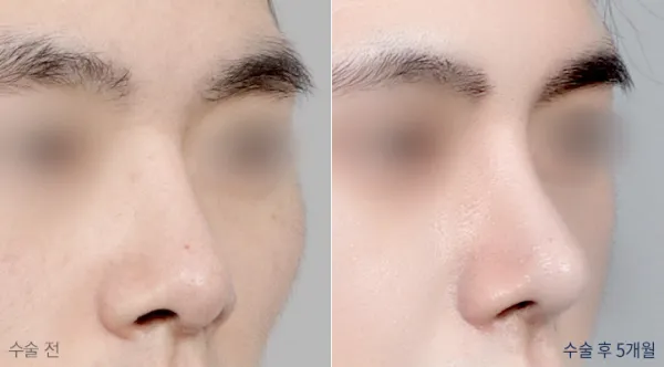 Before/After