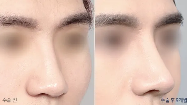 Before/After