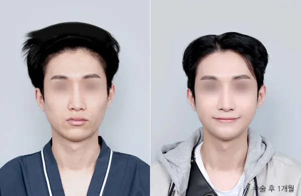 Before/After