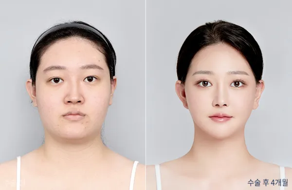 Before/After