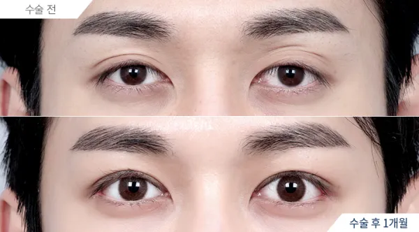 Before/After