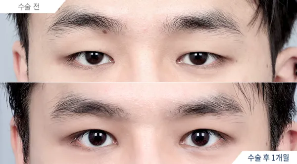 Before/After