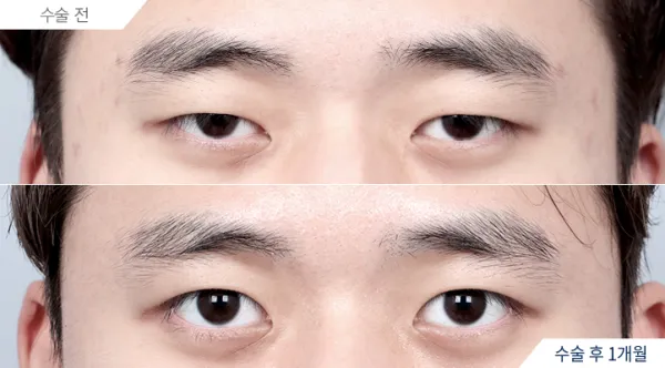 Before/After
