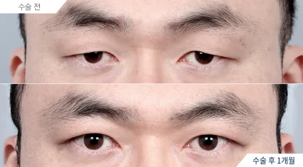 Before/After