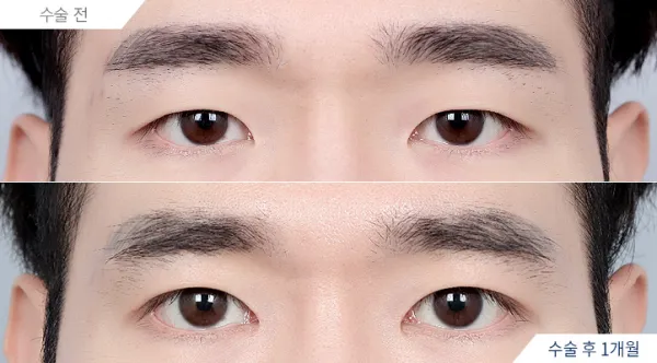 Before/After