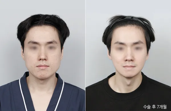 Before/After
