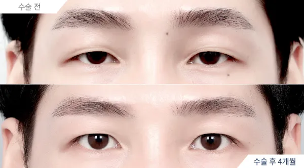 Before/After