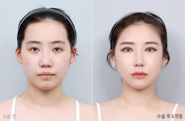 Before/After